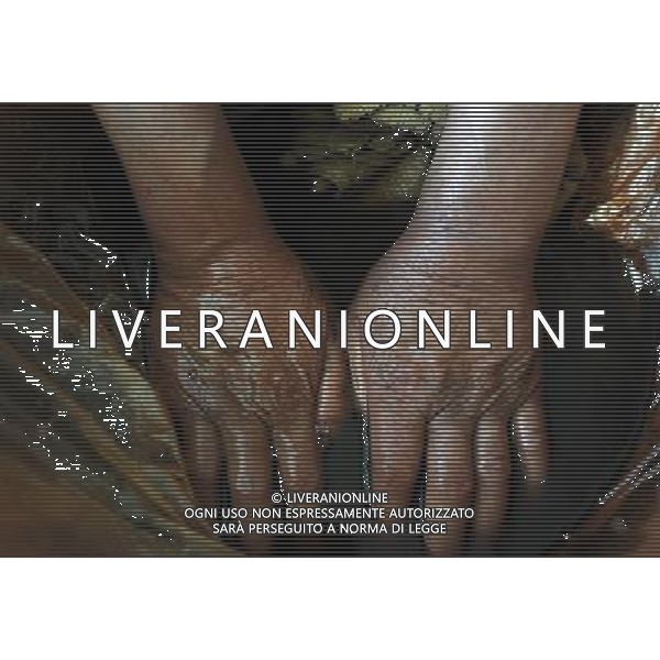 (110802) -- LANZHOU, Aug. 2, 2011 () -- A patient receives a treatment of hands bath in the herbal medicine soup at the Traditional Chinese Medicine Hospital in Liangzhou District, Wuwei City, northwest China\'s Gansu Province, July 29, 2011. On July 29 in a village clinic, Chang Faguo, 70, of the Luzhou village, receives herbal drugs from doctor Zhang Yuwen of Ma\'er Village neighbouring Luzhou and then rides home. Luzhou, located in the Wuwei City\'s Liangzhou District in northwest China\'s Gansu Province, is one of the impoverished villages in the poor province. Herbal drugs are very common in Liangzhou where most of the village doctors are skillful at the Traditional Chinese Medicine (TCM). \'Compared with Western medicines, herbal drugs are really cheap for farmers, especially in treating chronic diseases,\' Zhang said, \'take Chang for example, he needs a long-term medication as he has suffered from chronic stomach disease for nearly 20 years. Conventional chemical drugs will cost him 24 RMB yuan every two days whereas the TCM herbs only need 14 RMB yuan. Saving 10 RMB yuan matters much for a famer\'s family whose annual income is merely 5,000 RMB yuan.\' After the founding of the People\'s Republic of China in 1949, rural people had access to subsidized health clinics run by \'barefoot doctors,\' who were basically middle-school students trained in first aid. Those \'barefoot doctors\' used to prescribe herbs to treat diseases for farmers, which were common and easy to obtain in the countryside. The primitive service, essentially free, played a role in doubling the country\'s average life expectancy from 35 years in 1949 to 68 years in 1978. When China began its economic reform in the early 1980s, the system was dismantled as the country attempted to switch to a market-oriented healthcare system. But the government failed to establish a viable substitute, leaving its large rural population without health insurance. A national health survey in 2003 revealed abou